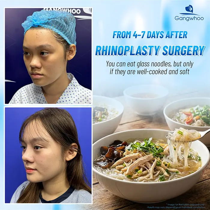 Can You Eat Glass Noodles After Rhinoplasty? How Long Should You Wait?