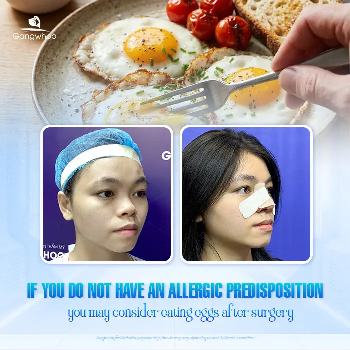 Can You Eat Eggs After Rhinoplasty? How Long Should You Avoid Them?