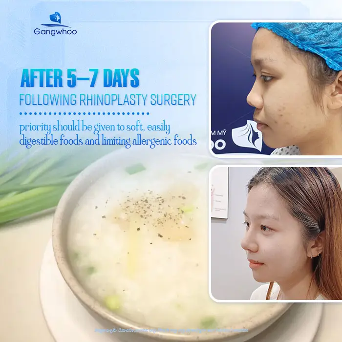 Can You Eat Eggs After Rhinoplasty? How Long Should You Avoid Them?