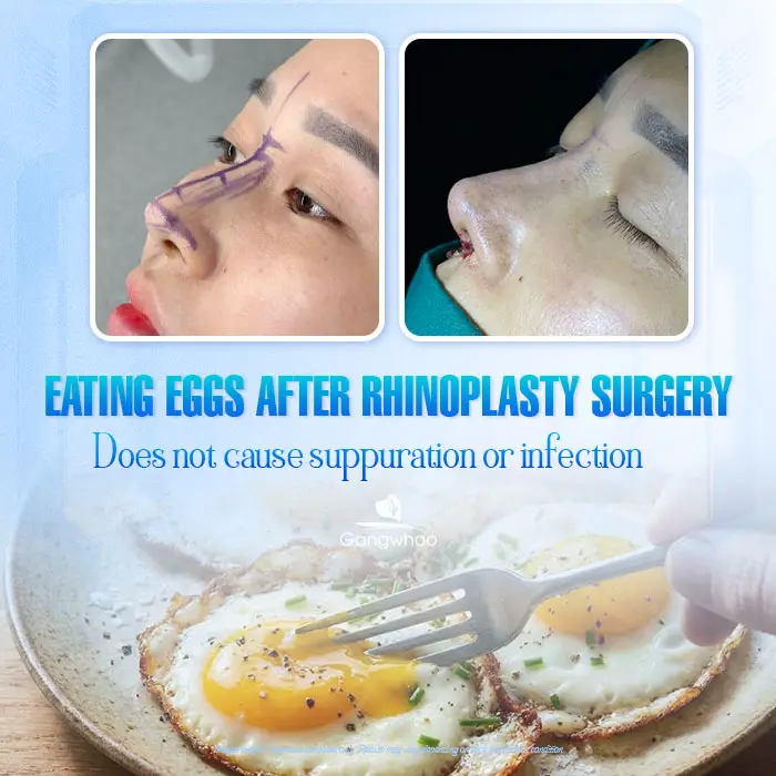 Can You Eat Eggs After Rhinoplasty? How Long Should You Avoid Them?