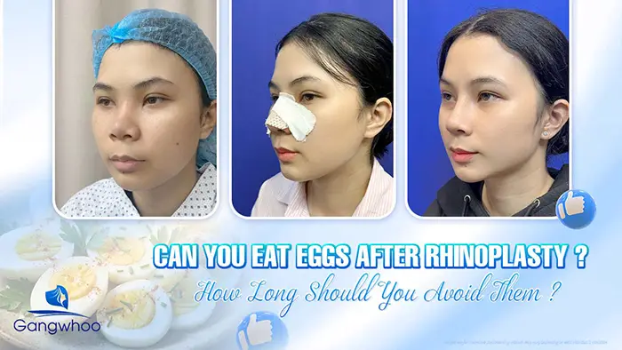 Can You Eat Eggs After Rhinoplasty? How Long Should You Avoid Them?