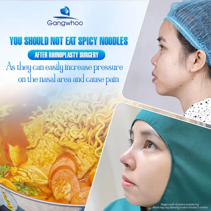 How Long After Rhinoplasty Can You Eat Spicy Noodles? A Safe Timeline According to Doctors