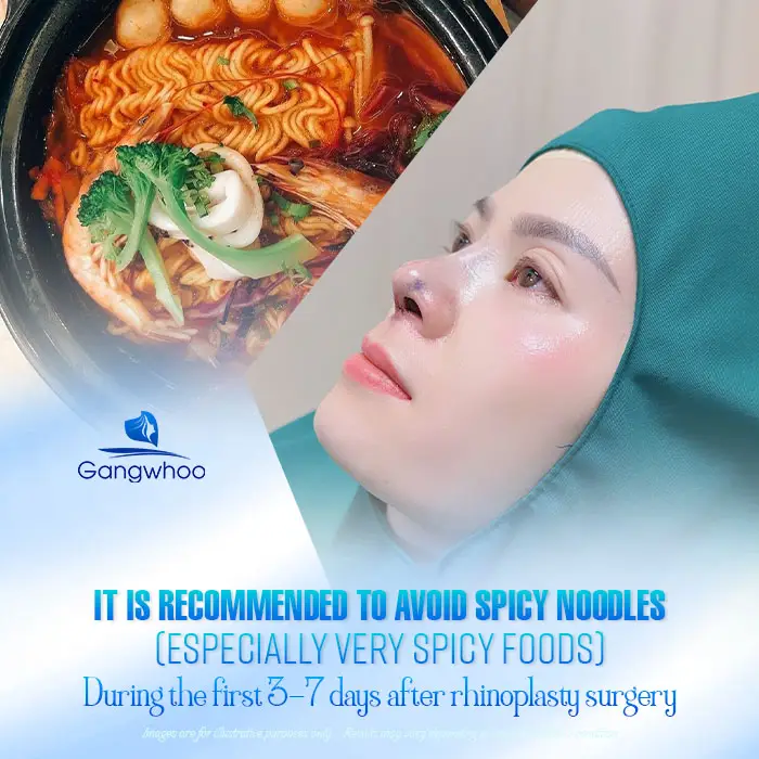 How Long After Rhinoplasty Can You Eat Spicy Noodles? A Safe Timeline According to Doctors