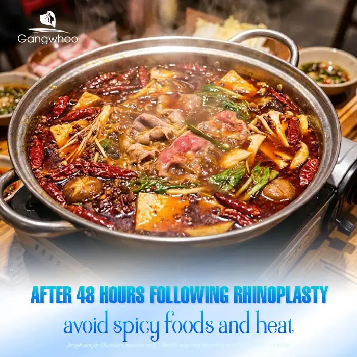 How Long After Rhinoplasty Can You Eat Spicy Noodles? A Safe Timeline According to Doctors