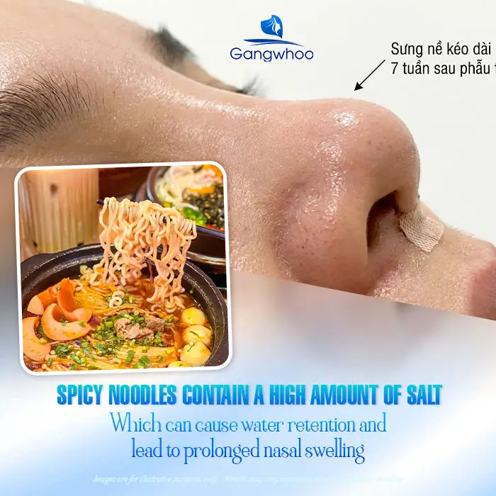 How Long After Rhinoplasty Can You Eat Spicy Noodles? A Safe Timeline According to Doctors