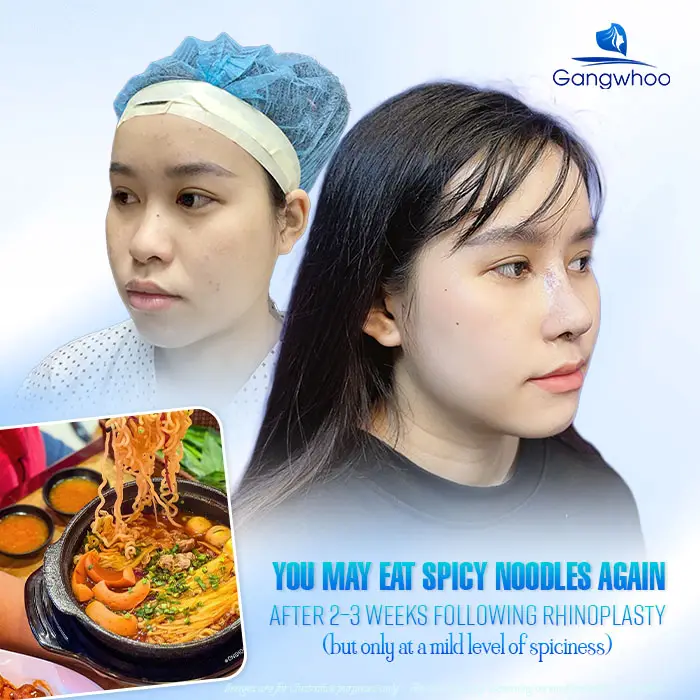 How Long After Rhinoplasty Can You Eat Spicy Noodles? A Safe Timeline According to Doctors