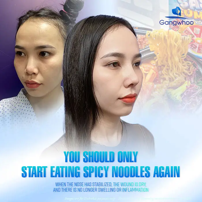 How Long After Rhinoplasty Can You Eat Spicy Noodles? A Safe Timeline According to Doctors
