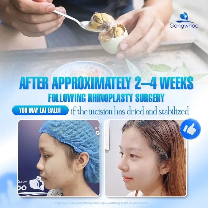 How Long After Rhinoplasty Can You Eat Balut? A Doctor Explains