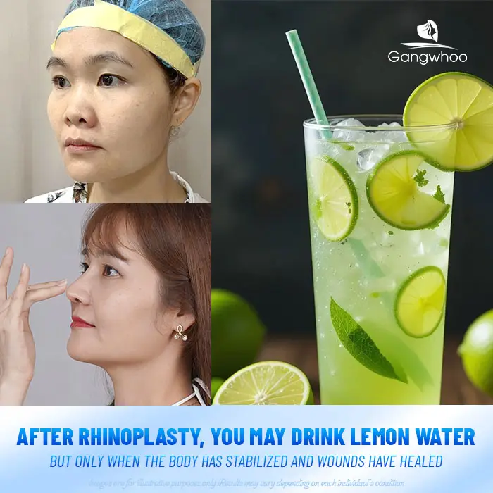 Can You Drink Lemon Water After Rhinoplasty? Doctor’s Explanation