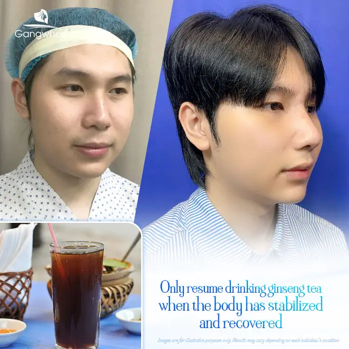 Can You Drink Ginseng Tea After Rhinoplasty? A Specialist’s Explanation