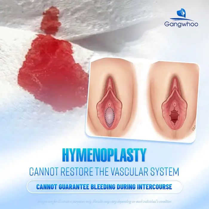 Will There Be Bleeding During Intercourse After Hymen Repair? Doctor’s Explanation