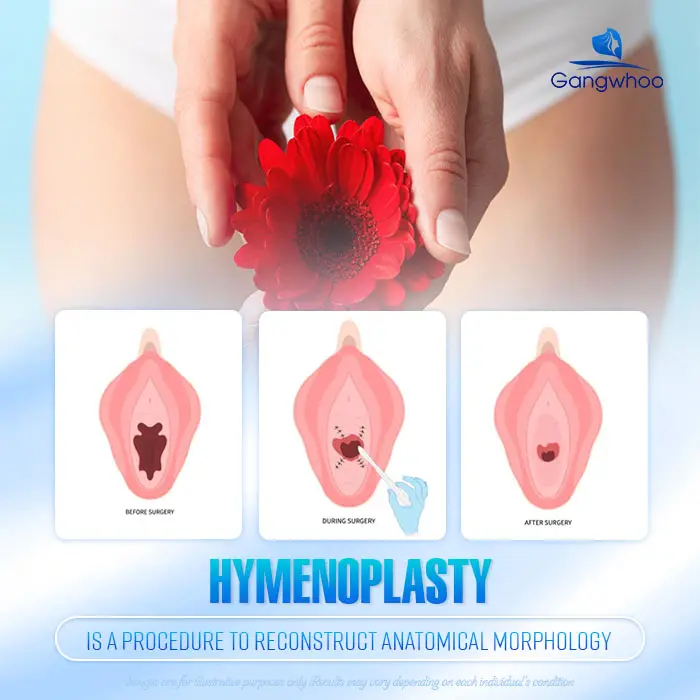 Will There Be Bleeding During Intercourse After Hymen Repair? Doctor’s Explanation