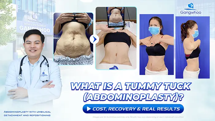 Tummy Tuck (Abdominoplasty): What Is It? Cost, Recovery & Real Results
