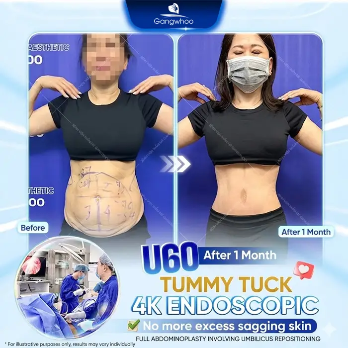 Abdominoplasty: What Is It? Cost, Recovery & Real Results