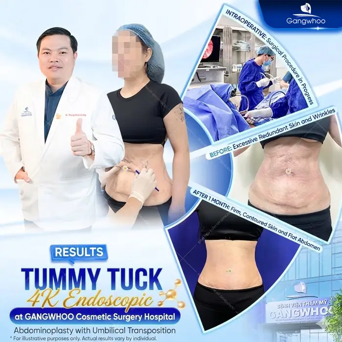 Abdominoplasty: What Is It? Cost, Recovery & Real Results