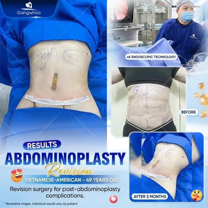 Abdominoplasty: What Is It? Cost, Recovery & Real Results