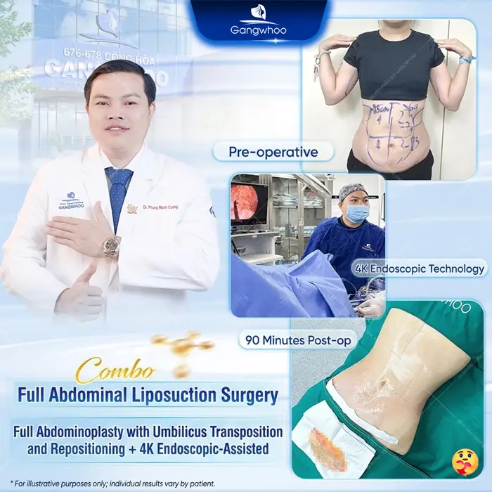 Abdominoplasty: What Is It? Cost, Recovery & Real Results