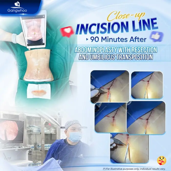 Abdominoplasty: What Is It? Cost, Recovery & Real Results