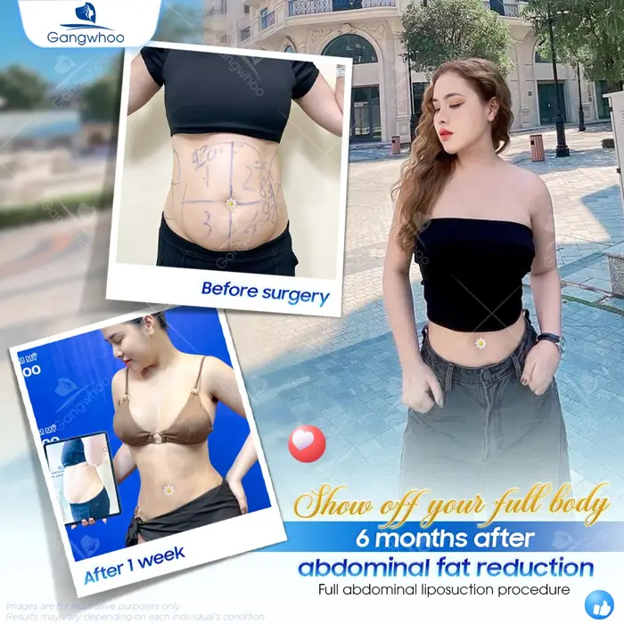 Top 5 Best Liposuction in Vietnam: Safe, Affordable & Trusted Clinics (2026 Guide)