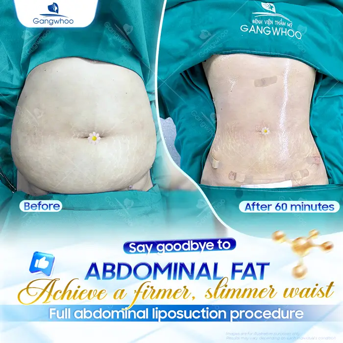 Top 5 Best Liposuction in Vietnam: Safe, Affordable & Trusted Clinics (2026 Guide)