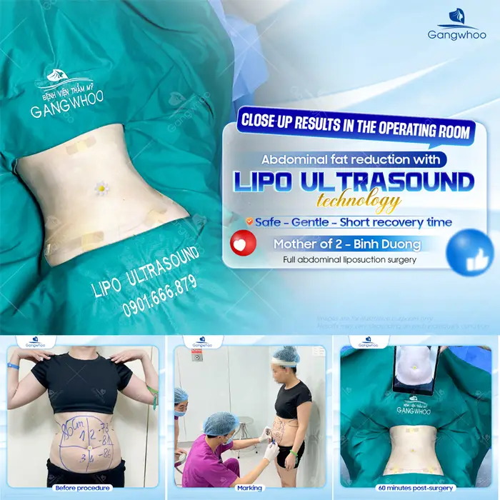 Top 5 Best Liposuction in Vietnam: Safe, Affordable & Trusted Clinics (2026 Guide)