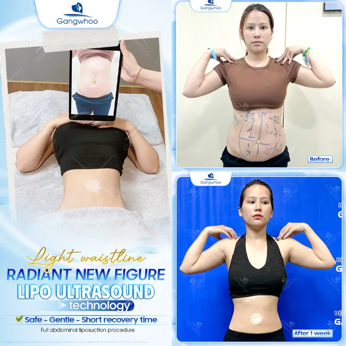 Top 5 Best Liposuction in Vietnam: Safe, Affordable & Trusted Clinics (2026 Guide)