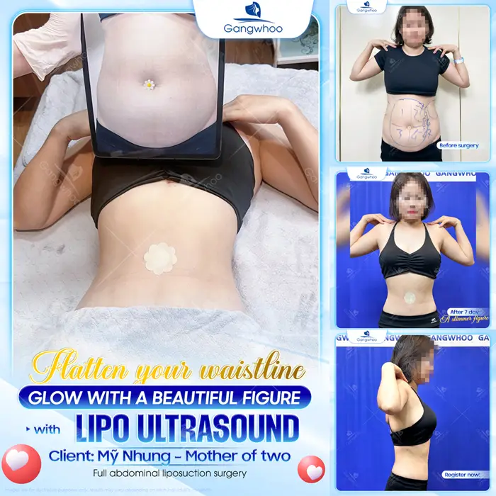 Top 5 Best Liposuction in Vietnam: Safe, Affordable & Trusted Clinics (2026 Guide)