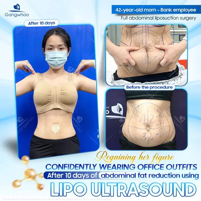 Top 5 Best Liposuction in Vietnam: Safe, Affordable & Trusted Clinics (2026 Guide)