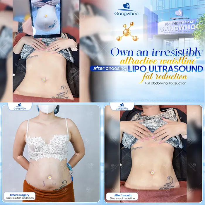 Top 5 Best Liposuction in Vietnam: Safe, Affordable & Trusted Clinics (2026 Guide)
