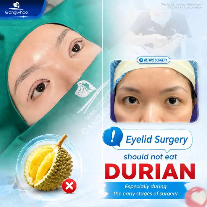 Can I Eat Durian After Double Eyelid Surgery? Detailed Doctor’s Answer