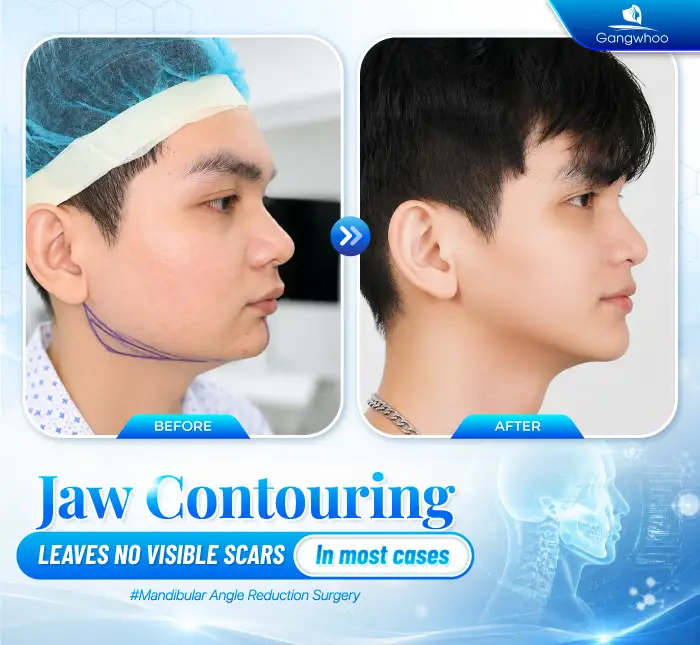 Does Jaw Reduction Surgery Leave Scars? Cases That May Increase the Risk of Scarring