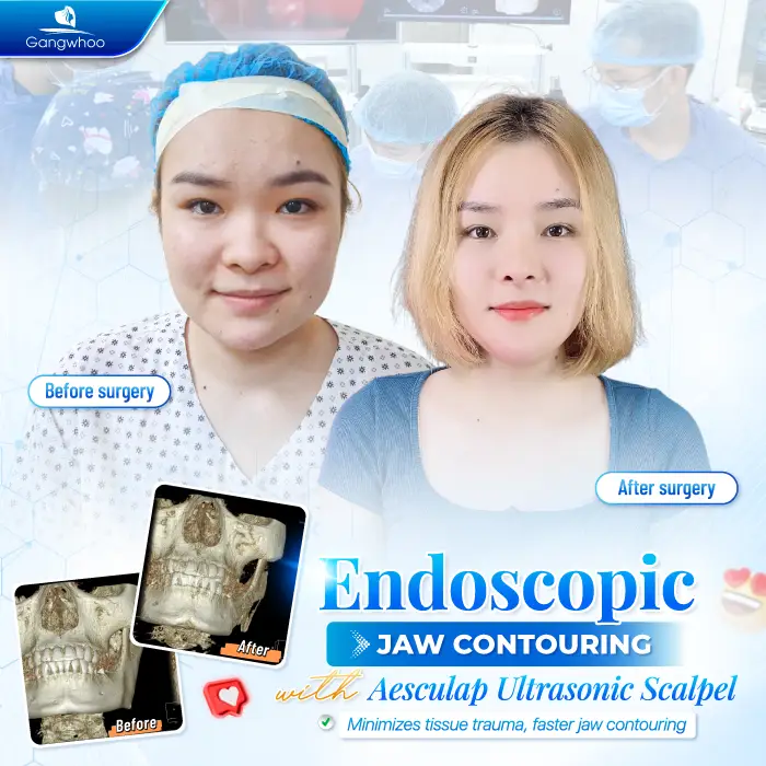 Does Jaw Reduction Surgery Leave Scars? Cases That May Increase the Risk of Scarring