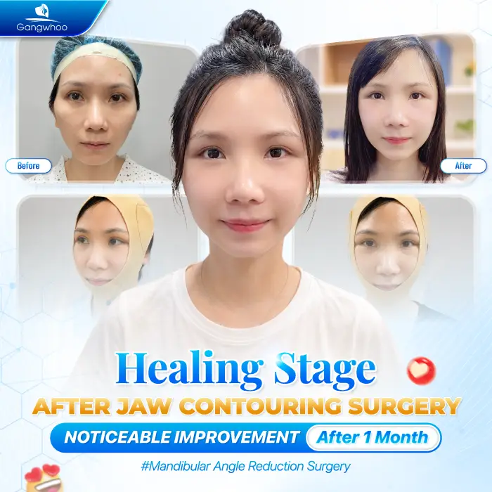 Does Jaw Reduction Surgery Leave Scars? Cases That May Increase the Risk of Scarring