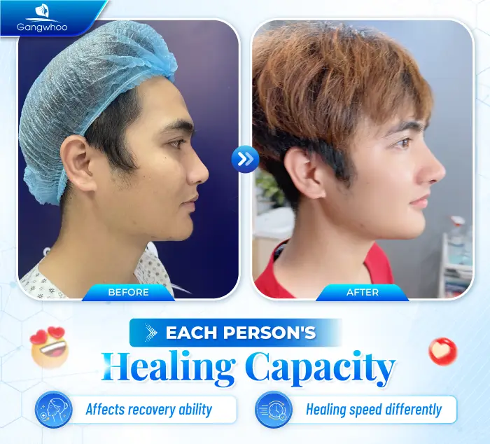 Does Jaw Reduction Surgery Leave Scars? Cases That May Increase the Risk of Scarring