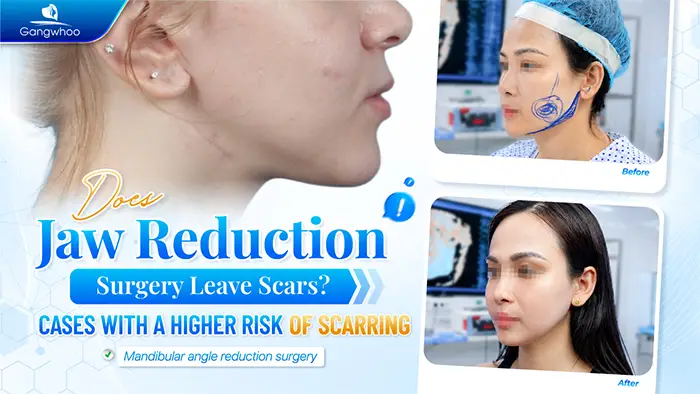 Does Jaw Reduction Surgery Leave Scars? Cases That May Increase the Risk of Scarring