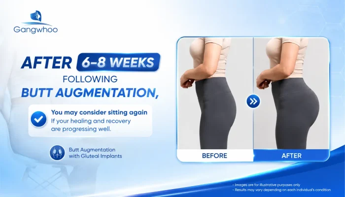 How Long After Butt Augmentation Can You Sit? A Medically Guided Recovery Timeline