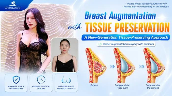 Breast Augmentation with Tissue Preservation: A New-Generation Tissue-Preserving Approach