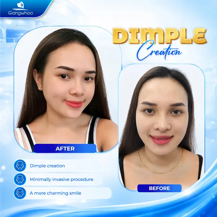 What Is a Dimple? Meaning and How to Create Natural, Beautiful Dimples