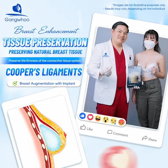 Breast Augmentation with Tissue Preservation: A New-Generation Tissue-Preserving Approach