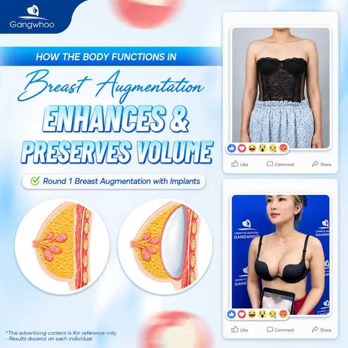 Breast Augmentation with Tissue Preservation: A New-Generation Tissue-Preserving Approach