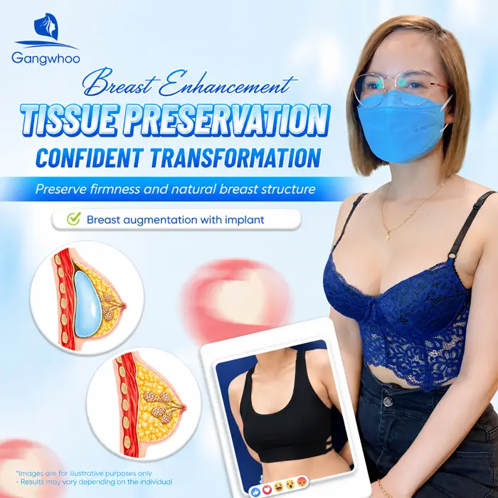 Breast Augmentation with Tissue Preservation: A New-Generation Tissue-Preserving Approach