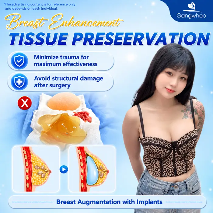 Breast Augmentation with Tissue Preservation: A New-Generation Tissue-Preserving Approach