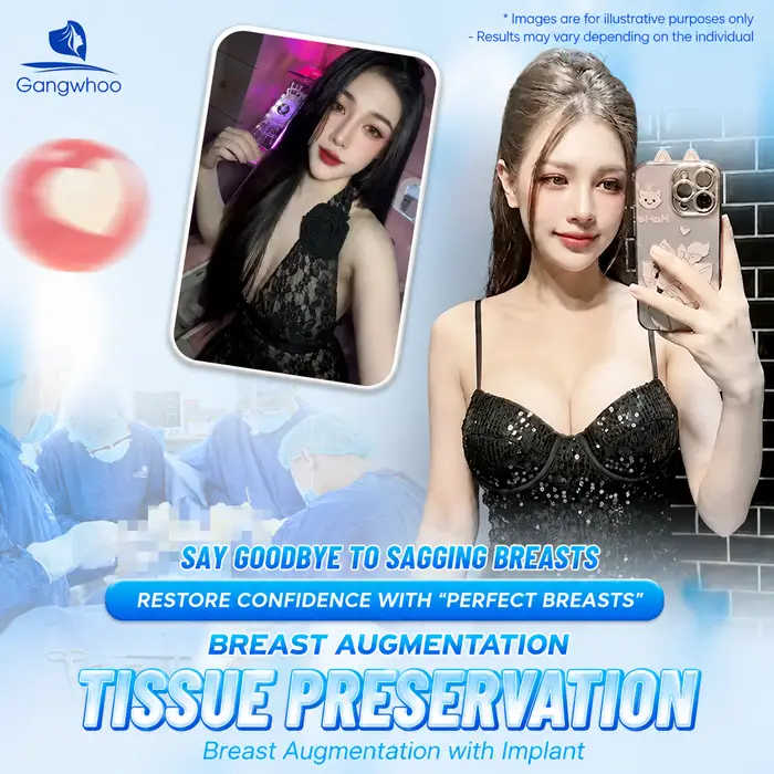 Breast Augmentation with Tissue Preservation: A New-Generation Tissue-Preserving Approach