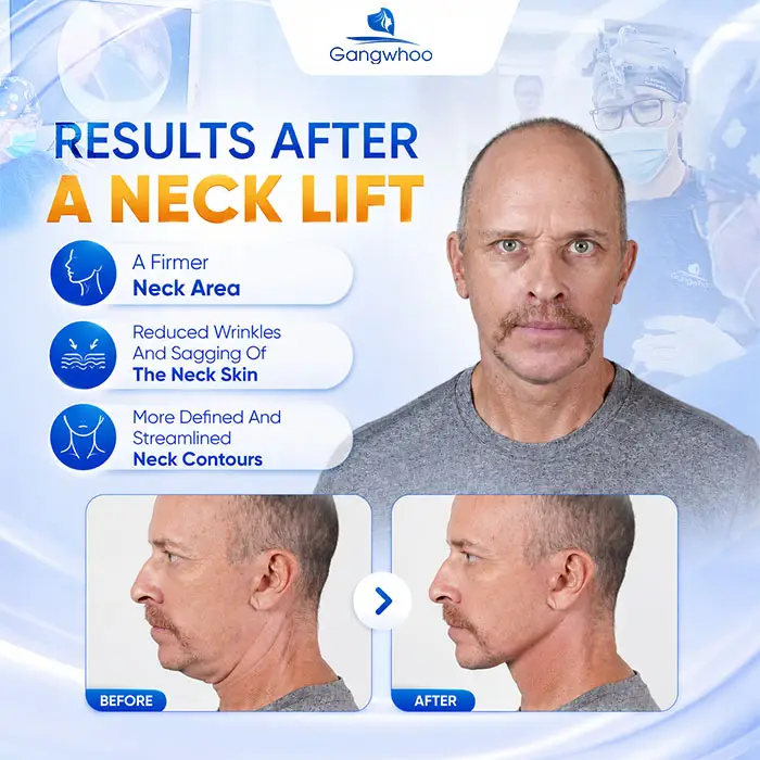 Neck Lift Cost: New 2026 Price List