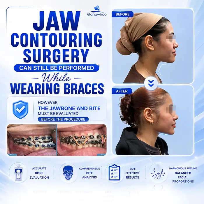 Can I Have Jaw Contouring Surgery While Wearing Braces? Doctor’s Answer
