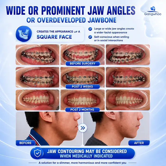 Can I Have Jaw Contouring Surgery While Wearing Braces? Doctor’s Answer