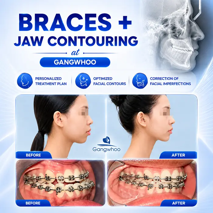 Can I Have Jaw Contouring Surgery While Wearing Braces? Doctor’s Answer