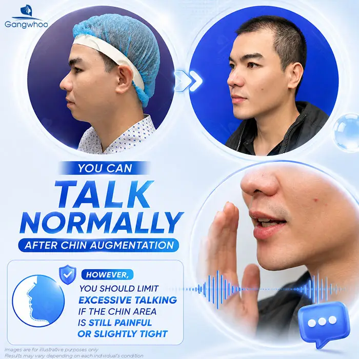 How Long After Chin Augmentation Can You Smile? Recovery Care Guide