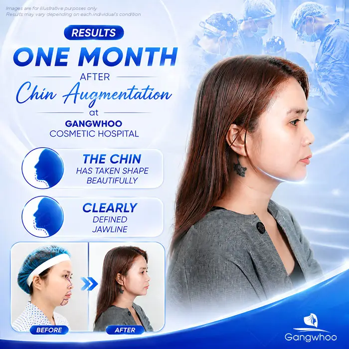 How Long After Chin Augmentation Can You Smile? Recovery Care Guide