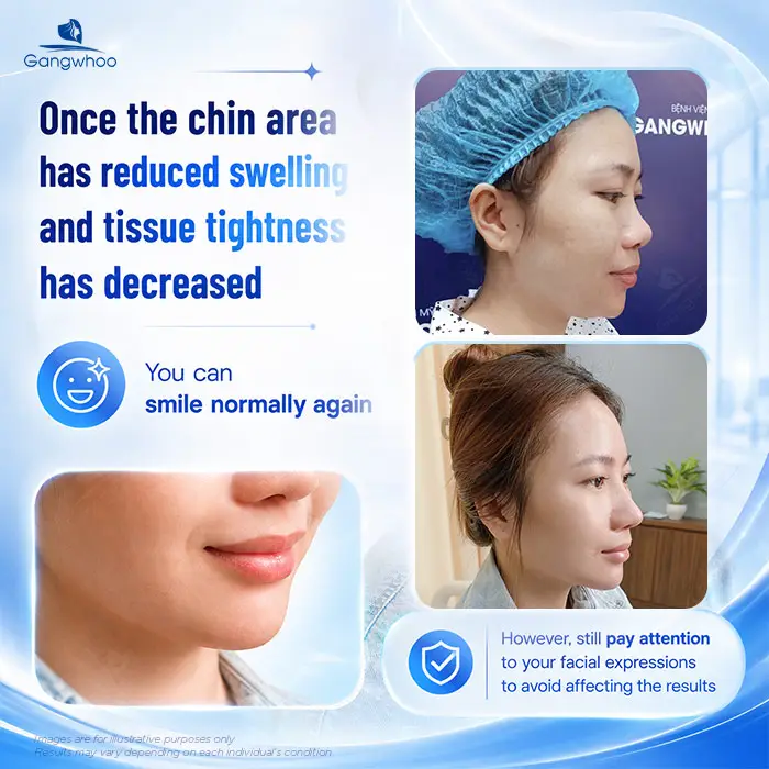 How Long After Chin Augmentation Can You Smile? Recovery Care Guide